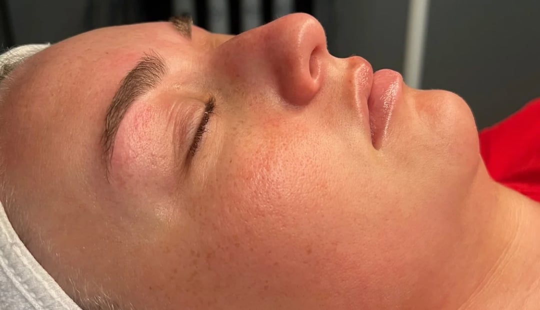 After dermaplane