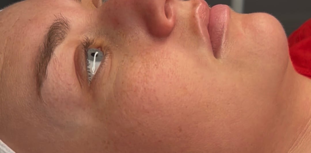 Before dermaplane