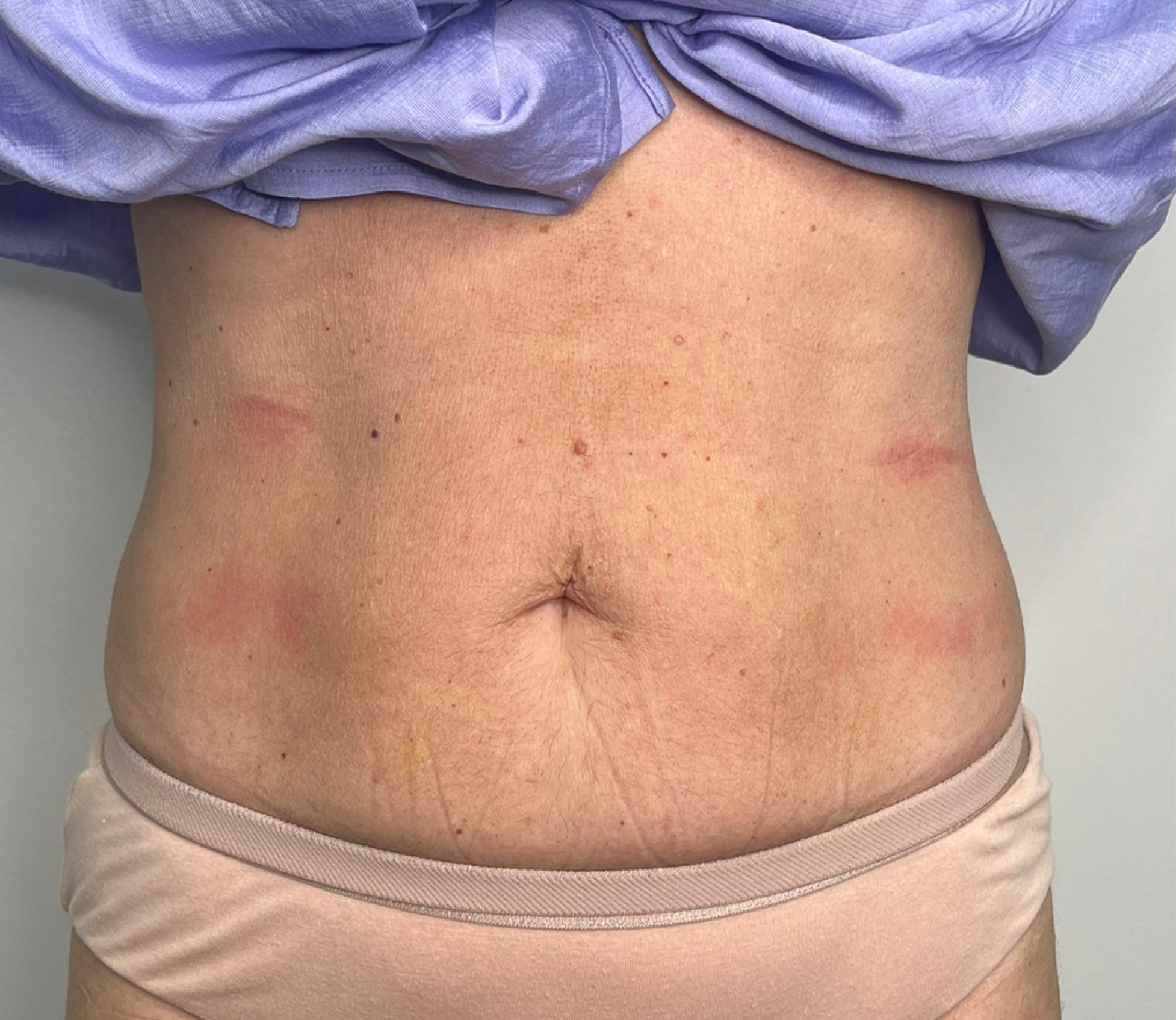 After Emsculpt Neo, abdomen