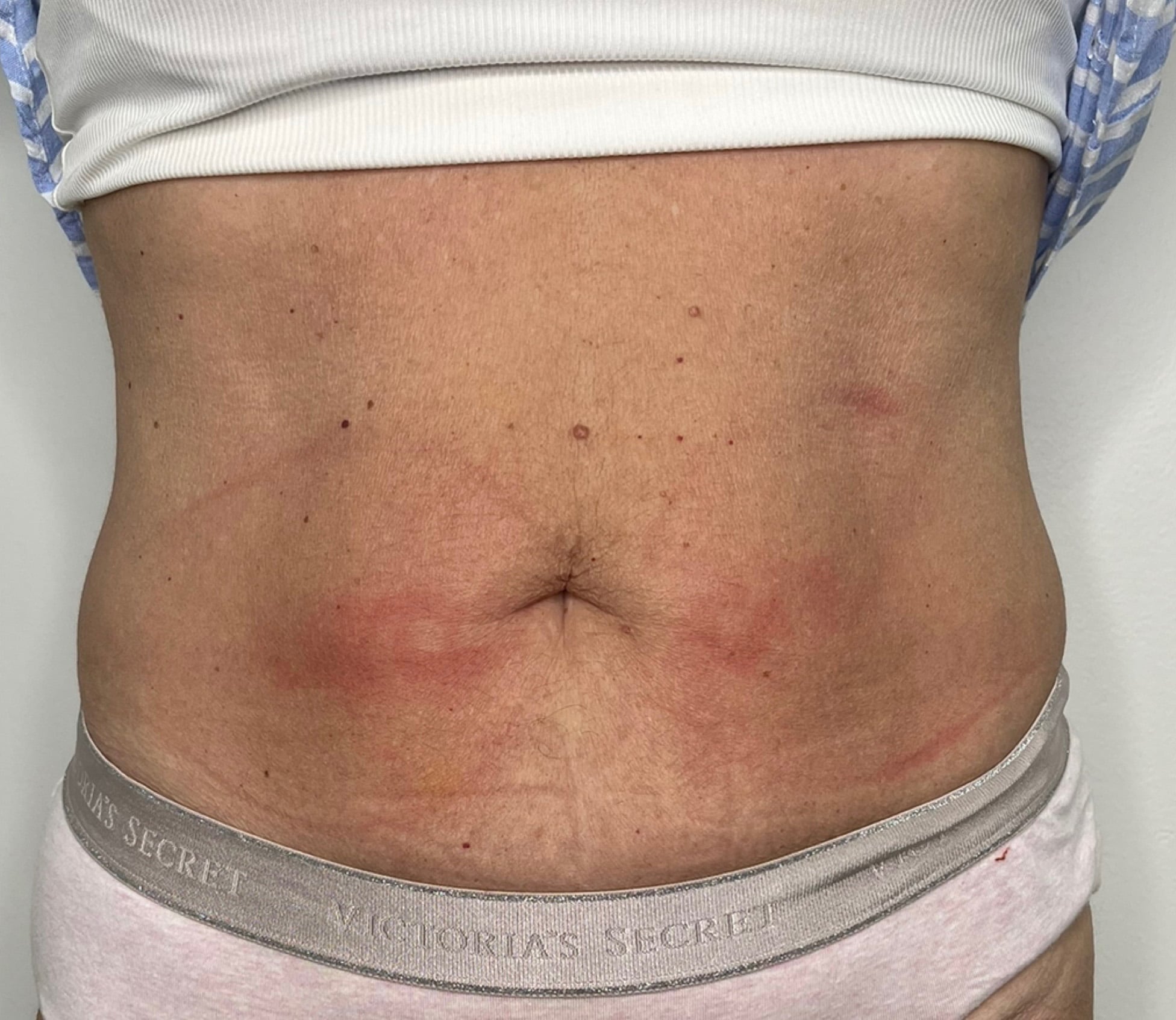 Before Emsculpt Neo, abdomen