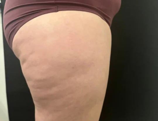 Before Emsculpt Neo, thighs