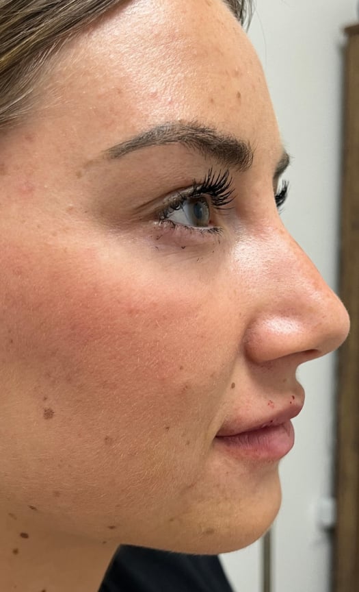 After filler