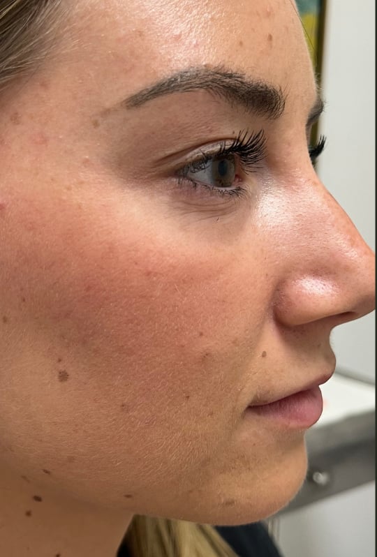 Before filler
