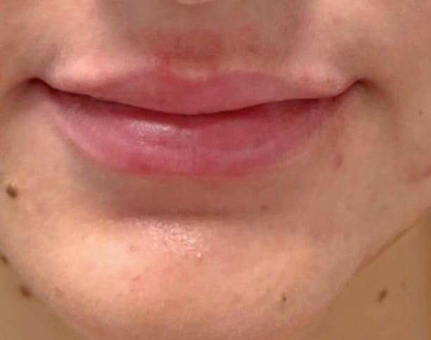 After filler, case 2