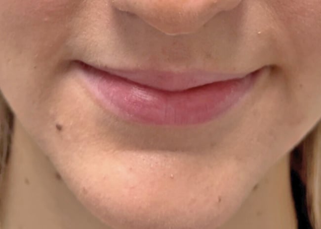 Before filler, case 2