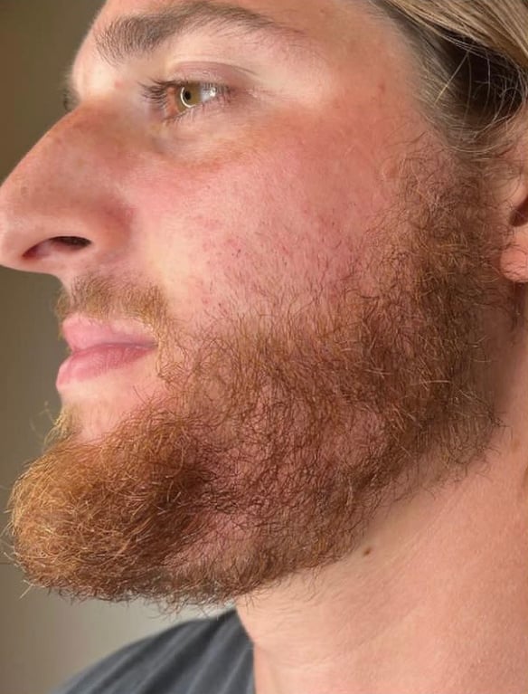Before Keravive beard