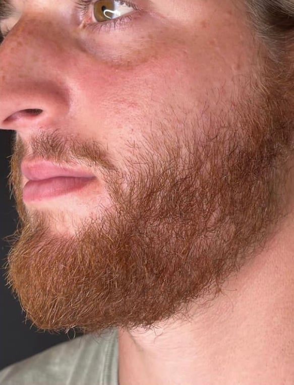 After Keravive beard
