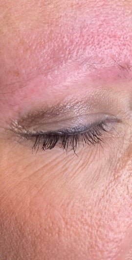 Before Keravive brow