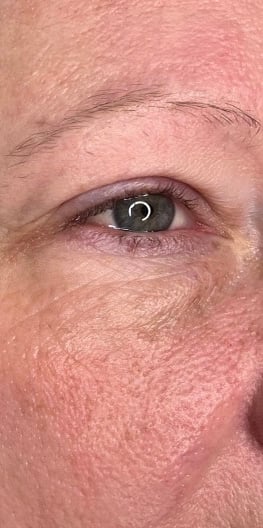 After Keravive brow