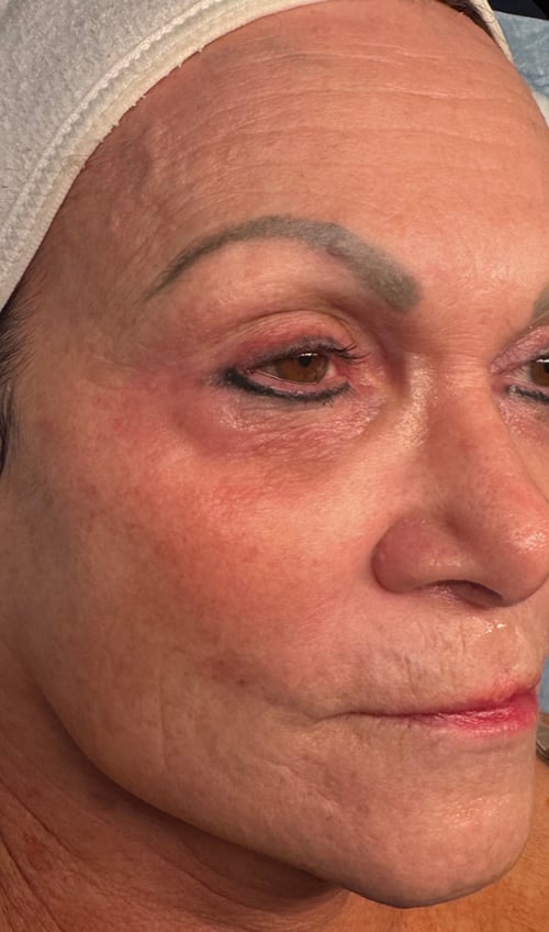After SkinPen and Exosome Glide at Revive Wellness Clinic