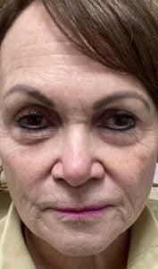 Before SkinPen and Exosome Glide at Revive Wellness Clinic