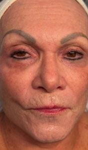 After SkinPen and Exosome Glide at Revive Wellness Clinic