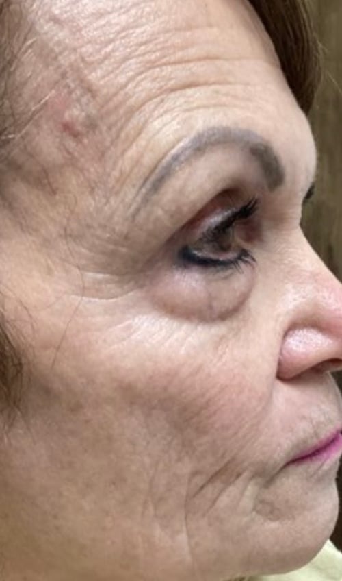 Before SkinPen and Exosome Glide at Revive Wellness Clinic